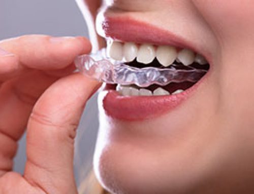 ClearCorrect Aligners