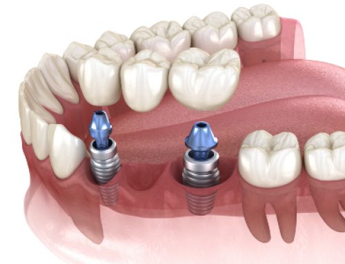 Dental Implants: What can they do?