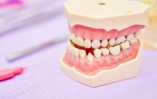 Malocclusion on Model Teeth