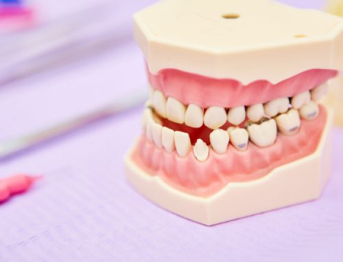 What Is Malocclusion?