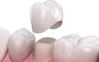 Placement of a Premolar Dental Crown